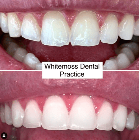 Composite Bonding Results