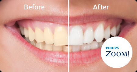 Teeth Whitening